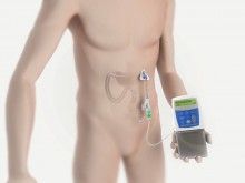 pompe &agrave; Duodopa